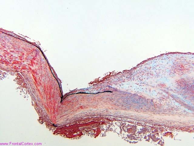 Transition from arterial wall to aneurysm sac, Movat pentachrome stain